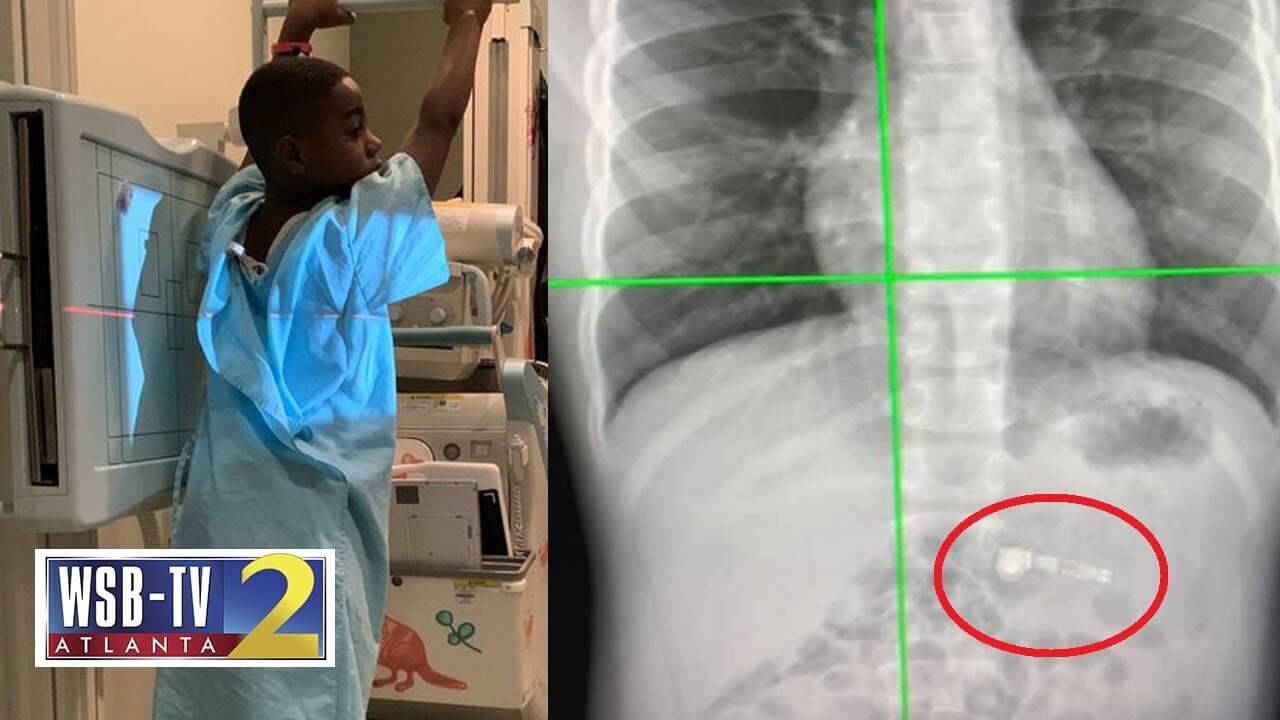 Дети тоже частенько глотают AirPods. Фото.