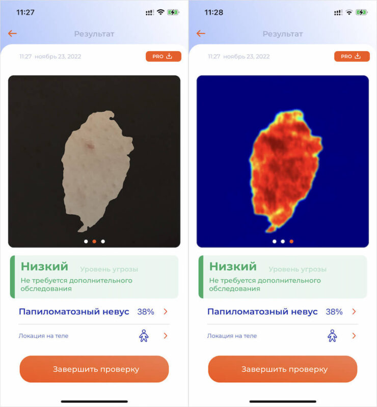 Опасна родинка или нет — как узнать. Skinive определяет признаки заболевания не просто наобум, а распознаёт конкретные фрагменты на вашей коже и отмечает их. Опасна родинка или нет — как узнать. Skinive определяет признаки заболевания не просто наобум, а распознаёт конкретные фрагменты на вашей коже и отмечает их. Фото.